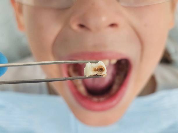 Best Emergency Treatment for Dental Infections or Abscesses in Williamsburg, FL
